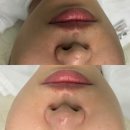 마전풍림2차아파트경로당 | 김포여드름 관리 받고 온 솔직 후기! 피부 컨디션이 달라졌어요