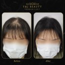 헤어라인두피문신, 후기가 많을 수 밖에 없는 이유