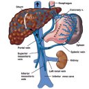 경내경정맥 간내문맥-간정맥 단락술(TIPS) 이미지