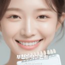 부천미백치과 :: 전문가미백 여름휴가 이벤트