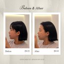 롯데리아 전주에코점 | 전주윤곽관리 에코시티윤곽관리 6회차 : 예라인에스테틱 전주점