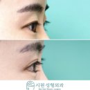 메이크유성형외과의원 | 밑트임과 안검내반 : 밑트임 후 안검내반의 발생원인과 회복 및 안검내반의 치료