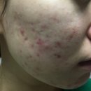 해들한의원 | 여드름한의원 치료 트러블 싹 압출 관리 후기