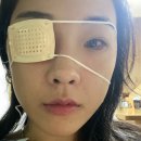 케이디(KD)밝은안과의원 | 성인 외사시 수술 당일 부터 수술 후 5일째까지 나의 느낀점