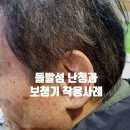 전주보청기 세계보청기 돌발성 난청으로 인한 보청기 착용 사례 이미지