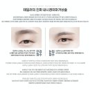 테일러성형외과의원 | 내시경이마거상술후기 섬세한 박리를 통해