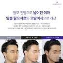 듀오성형외과의원 | 모앤라인│ 유전 탈모 남자 M자 이마, 가르마 헤어라인 교정 모발이식 8개월 후기!