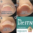 순천 내향성발톱,파고드는발톱 꼼꼼한 더블유뷰티!