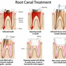 연세휴치과보존과치과의원 | 과천 치아보존 치료, 발치 전 한 번 더 확인해야 하는 것 <연세세이브치과>