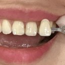 캐드캠치과기공소 | 분당 서현역 5번출구 도보 30초 치과 친절하고 대기시간 과대진료 없는 치과 추천