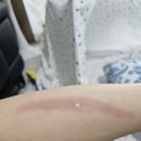 미보 | [임산부 화상] 임산부 화상 후기 | 화상 치료 | 미보 연고 | 병원 드레싱 | 통원과 회복기간