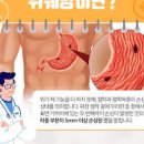 위궤양 초기 증상 급성 원인 어떻게 대처해야 할까? 이미지