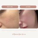 강남 청담동피부과 셀리뉴리프팅+울킨초음파관리로 탄력관리 만족후기 (feat.내돈내산)