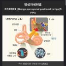 이석증:서울아산병원 이비인후과 1차 후기