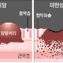 젊은 사람들에게도 장마사지를 권해야 하는 '미만성(瀰漫性) 위암' 이미지