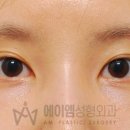 에이엠성형외과의원 네이버블로그