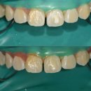 아이콘(icon)치과기공소 | 치아에 생긴 하얀 얼룩? 깎지 말고 '아이콘(Icon) 레진' 하세요!