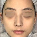 레드팬더 | 프로캄 레드엑스 멍크림 눈가 피멍 다크서클 사용 후기