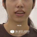 클리어치과교정과치과의원 | 개방교합으로 입술이 다물어지지 않아요!미아사거리 교정치과에서 설명드립니다.