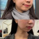 멍, 타임 | 압구정 온다리프팅 고통 없이 브이라인? 멍 붓기 제로 다운타임 후기