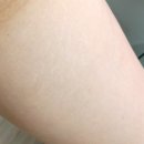 나의 허벅지 튼살커버 일대기 / 전후비교 포함 신림흉터관리 마고뷰티 후기
