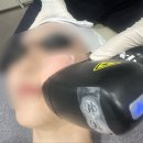 압구정튠의원 | [압구정로데오] 이승우의원 티타이너 후기ㅣ티타늄리프팅+튠라이너 💆🏻‍♀️🩶