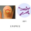 조갑백선 (Tinea unguium) 이미지