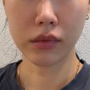 3웨이브 | 압구정로데오 피부과 힐로웨이브 팔자 앞볼 후기 중안부 효과(필러X)