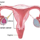 [여성전문병원]호산산부인과병원에서 난소암을 조기 검진 받자!!! 이미지