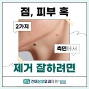 성모웰피부과의원 | 건대입구피부과 점 양성종양 제거 효과 후기 좋으려면