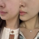 얼굴 | 을지로피부과 명동 온다리프팅 5만줄 얼굴 후기&gt;&lt;