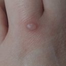 티엔피부과의원 | *손 사마귀 냉동치료 후기