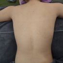 송도역 옥련동 피부관리 미드림 에스떼 등 후면 인비덤 맥스 조각관리 받고 온 후기