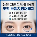 은삼성성형외과 | 부천 눈밑지방재배치, 다크서클과 인상 개선을 한번에 해결하는 방법