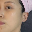 지한메디칼 | [강남/신논현] 좁쌀여드름 박멸 후기, 논현역 여드름 압출 관리 ✱ 보름달 뷰티 ✱