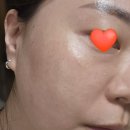 자여약국 | 피코슈어토닝 4회차 후기 (내돈내산)