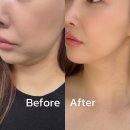 써니지니 | 의정부피부과 써니리프팅 잘하는 곳 다녀옴(솔직 후기)