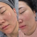 아그네스뷰티 | 김포 구래 모공전문 흉터전문 플라즈마관리로 새로운피부로 태어난 오드뷰티 솔직후기