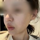 대의 | 세르프리프팅 삼십대의 세르프300샷 후기 (전후비교 유지기간)