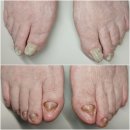 최강식내과의원 | 미아역 발톱무좀 관리│두꺼워진 노인발톱 발관리센터 후기