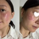 삼일목욕탕 | 대구 수성구 편평사마귀제거,기미제거,잡티제거 잘하는 피부과 내돈내산 후기