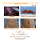 단일담석2.5cm수술후기. 담낭을 절제하고 새로 태어난 기분이에요. 튼튼병원과 김정윤 원장님 정말 감사드립니다. 이미지