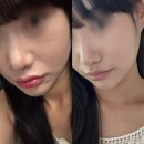 잠실환경노동조합 | 잠실역 피부과 포텐자 PDRN 콜라스터 시술 후기 통증 가격