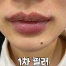 닥터에이치의원 | 입술 필러녹이기부터 재시술, 리터치까지 한 번에 정리한 영상