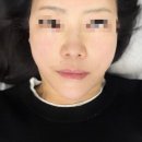 타이트짐 | 연산역 피부과 추천, 부산더블타이트 + 연어주사 솔직 더블타이트후기 (1~3주 변화 리얼 후기)