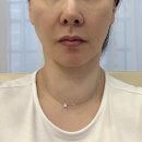 서울 강남역 피부과 추천 관리 올타이트, 셀리뉴 리프팅, 고우리 스킨부스터 가격 및 후기