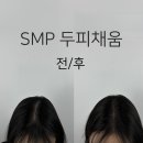 [구리 smp] 아크로매틱 smp, 정수리 케어 받고 온 후기