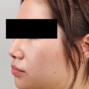 프리미의원 | 코끝필러 전후 후기, 유지기간 부작용까지