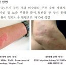 모기처럼 군데군데 원형 자국이 빈대 물렸을 때 대응법 기사 이미지