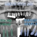 영양-1)영양군 서울치과 옆 동서교 | 광범위한 치아 상실 임플란트, 대구 임플란트 치과